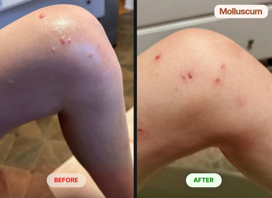 Removed molluscum