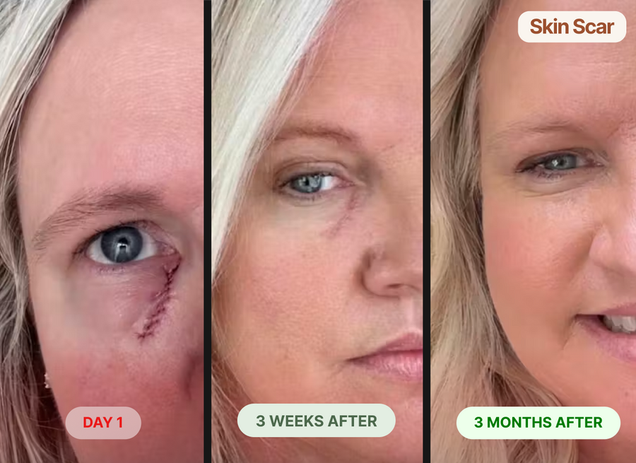 Has nearly eliminated my skin cancer scar!